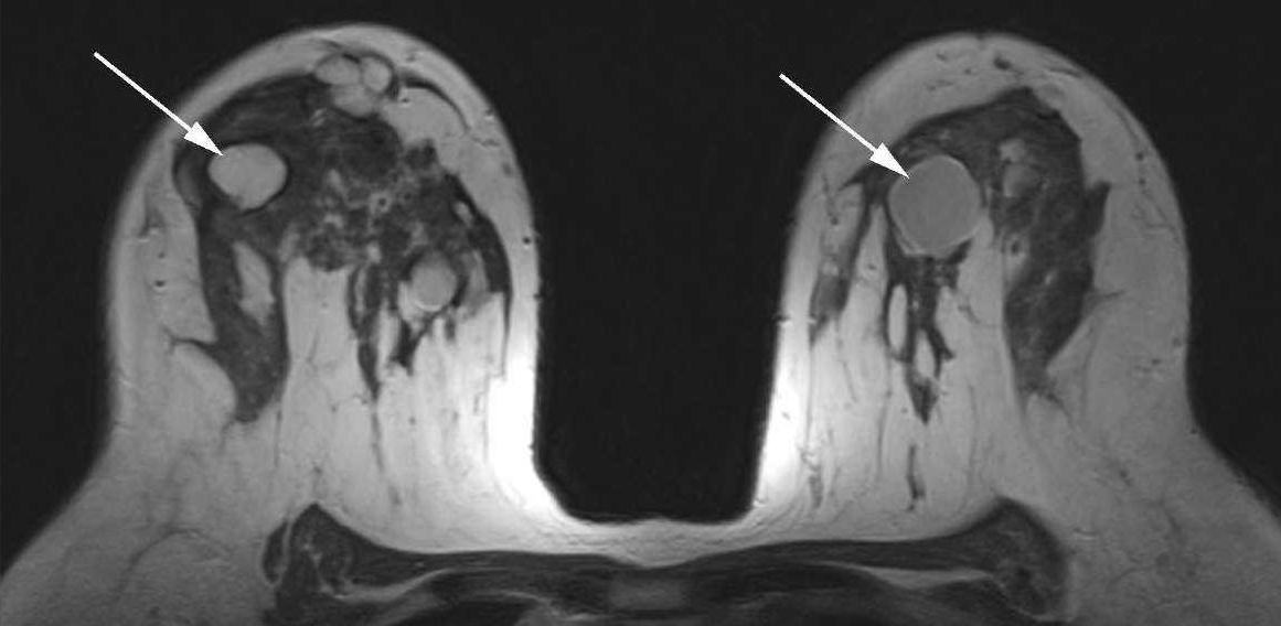 第2節(jié) 乳腺單純囊腫